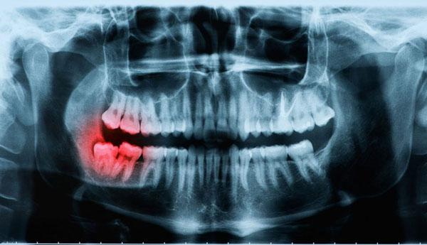 Một số trường hợp răng khôn mọc lệch gây nguy hiểm cần phải nhổ bỏ