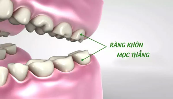 Trong một số trường hợp có thể bảo tồn giữ răng khôn