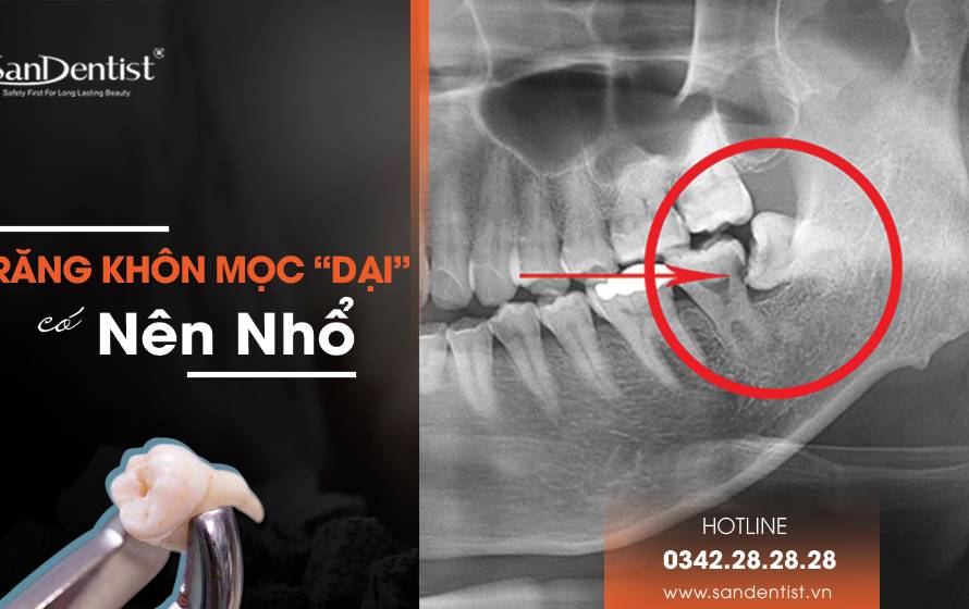 Răng khôn mọc "dại" có nên nhổ?