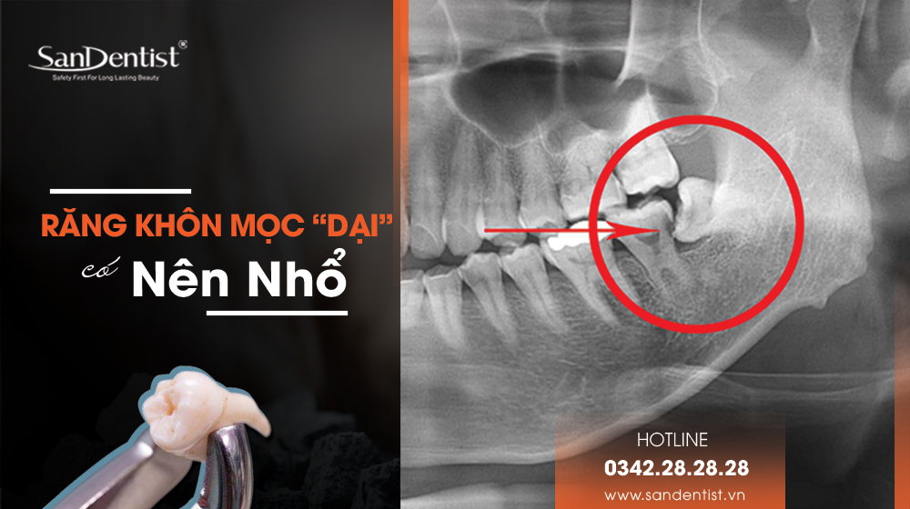 Răng khôn mọc "dại" có nên nhổ?