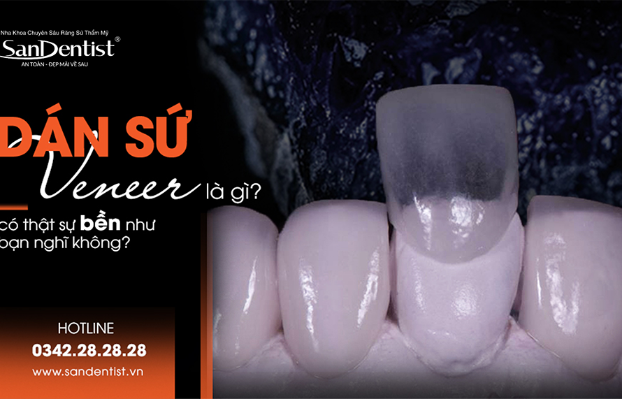 Dán sứ Veneer là gì