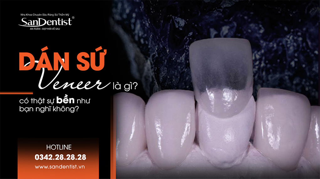 Dán sứ Veneer là gì
