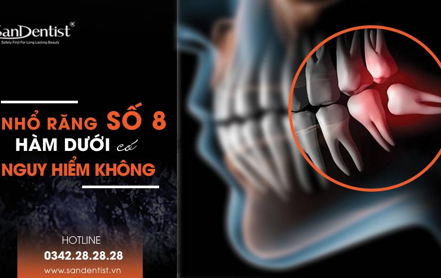 Nhổ răng khôn số 8 hàm dưới có nguy hiểm không?