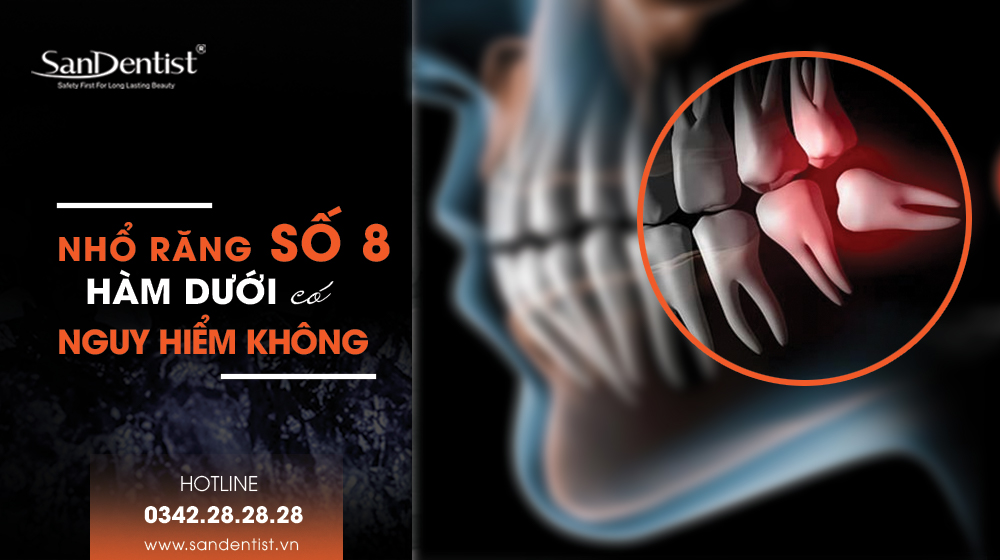 Nhổ răng khôn số 8 hàm dưới có nguy hiểm không?