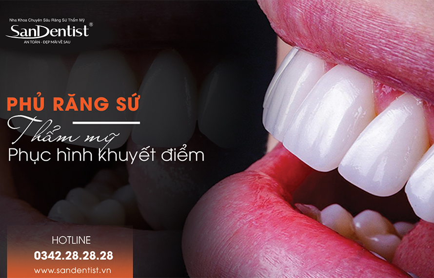 Phủ răng sứ thẩm mỹ