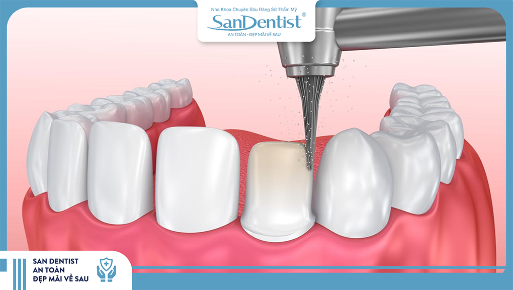 Kỹ thuật phủ sứ thẩm mỹ hạn chế việc mài răng