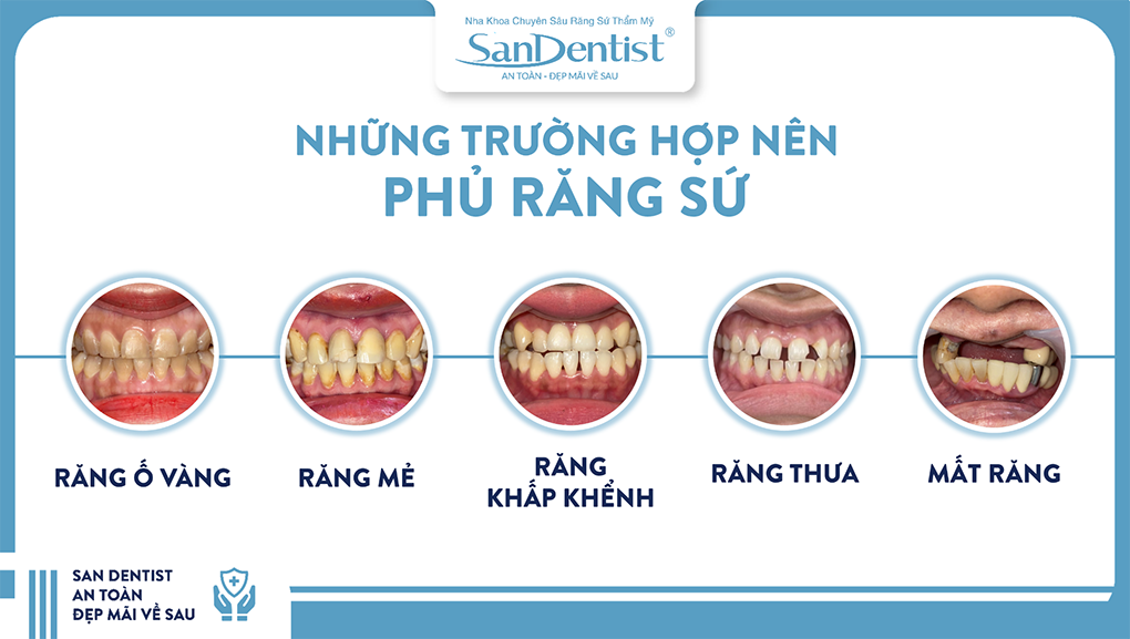 Phủ răng sứ thẩm mỹ thích hợp để phục hình các khiếm khuyết của răng