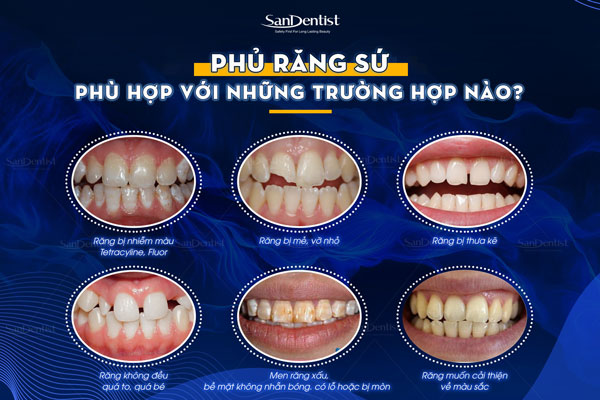 Một số trường hợp phủ răng sứ thẩm mỹ cho kết quả hoàn hảo