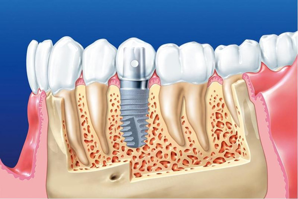 Cắm Implant