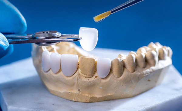 Dán Veneer được chế tạo từ khối sứ cao cấp, rất cứng cáp, tuổi thọ cao.