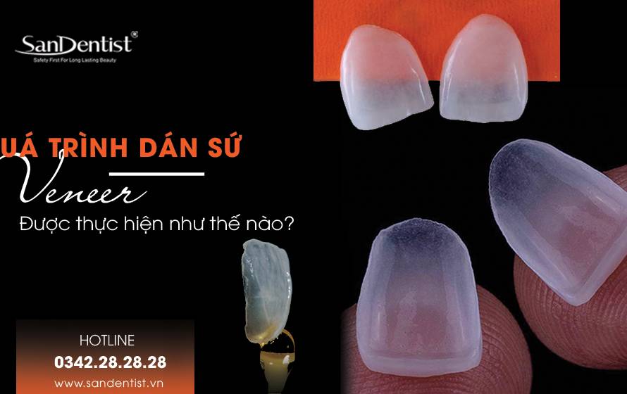 Quy trình dán sứ Veneer được thực hiện như thế nào?