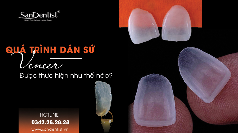 Quy trình dán sứ Veneer được thực hiện như thế nào?